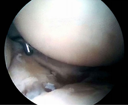 A combination of an anteromedial, anterolateral and midlateral portals is sufficient for 360° exposure of the radial head for arthroscopic fracture fixation. 2018