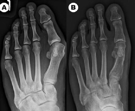 A comparison of Chevron and Lindgren-Turan osteotomy techniques in hallux valgus surgery: a prospective randomized controlled study 2016