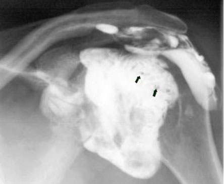 Comparison of subacromial tenoxicam and steroid injections in the treatment of impingement syndrome. 2015