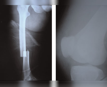 Ipsilateral femoral shaft and vertical patella fracture: a case report 2009