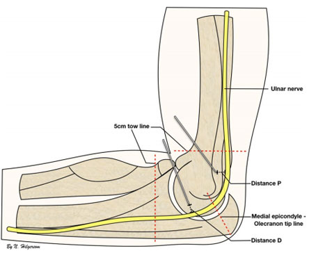 Locating the ulnar nerve during elbow arthroscopy using palpation is only accurate proximal to the medial epicondyle. 2018