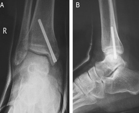 Open Mosaicplasty in Osteochondral Lesions of the Talus: A Prospective Study. 2012