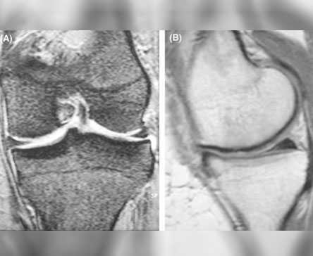 Risk of osteonecrosis of the femoral condyle after arthroscopic chondroplasty using radiofrequency: a prospective clinical series. 2009