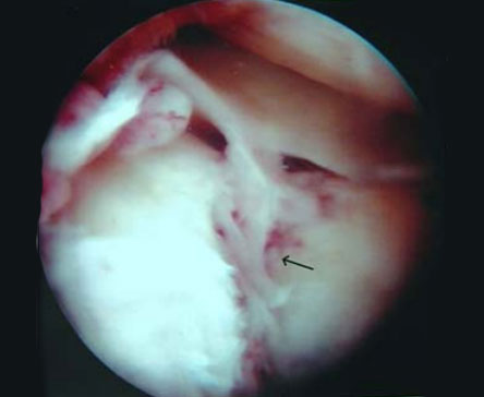 Second-look arthroscopy after arthroscopy-assisted treatment of tibial plateau fractures, 2007