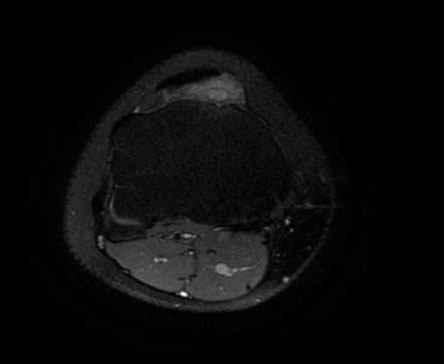 Synovial hemangiohamartoma presenting as knee pain, swelling and a soft tissue mass: a case report 2012
