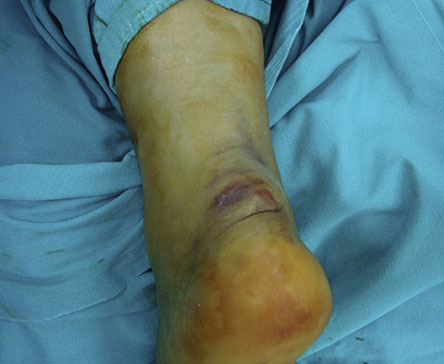 Transverse Incision for Calcaneal Tuberosity Avulsion Fractures. 2012