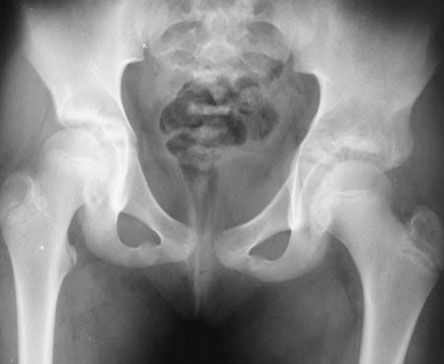 Treatment of Tönnis type II hip dysplasia with or without open reduction in children older than 18 months: A preliminary report, 2009